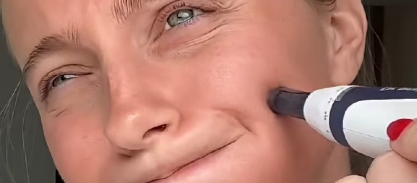 Microneedling-hurt-or-uncomfortable